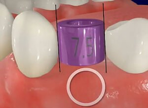 Implant Positioning Kit 2
