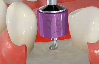 Positioning Implant Instruments Implant Positioning KIT – Dental Hub International