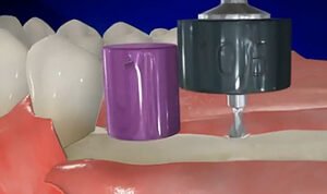 Implant Positioning Kit 4